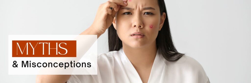 Acne Myths & Misconceptions