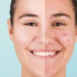 Acne The Complete Guide to Causes, Symptoms, and Natural Treatments