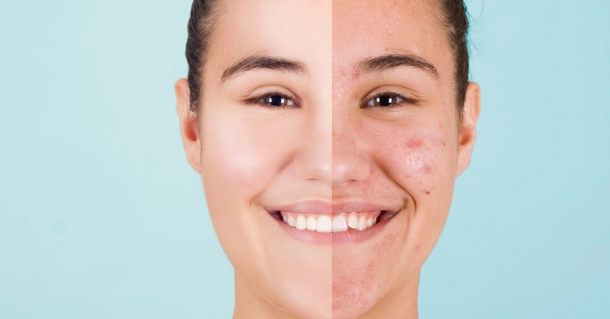 Acne The Complete Guide to Causes, Symptoms, and Natural Treatments