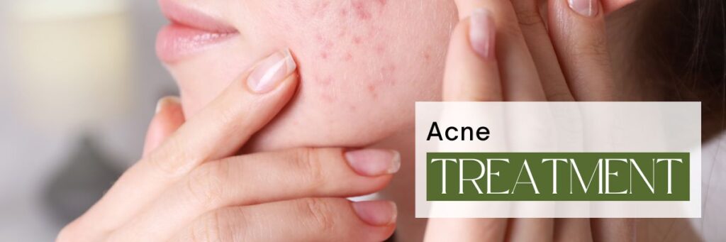 Acne Treatment Options