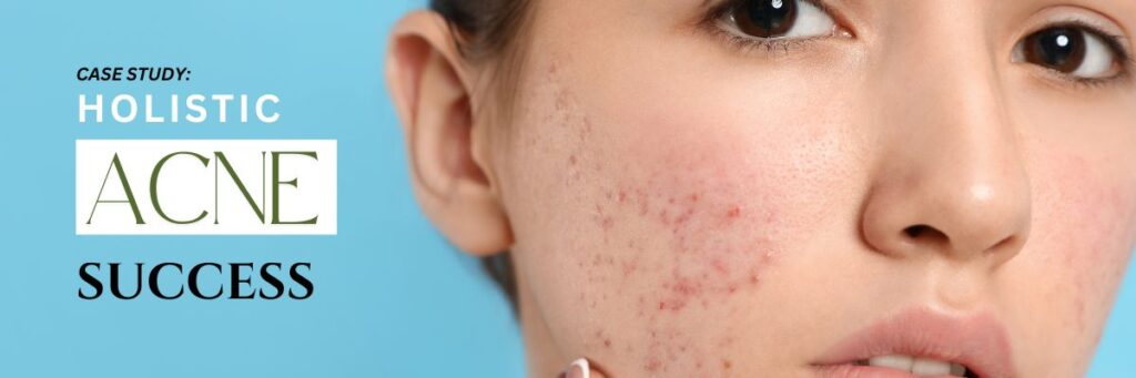 Case Study: Holistic Acne Success