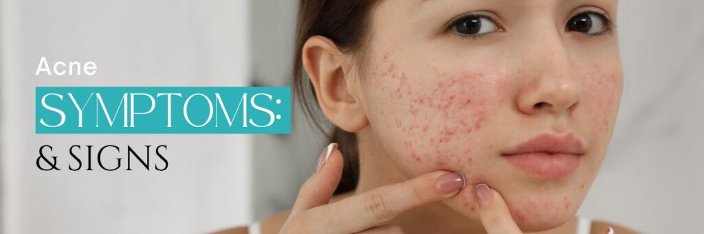 Symptoms & Signs of Acne