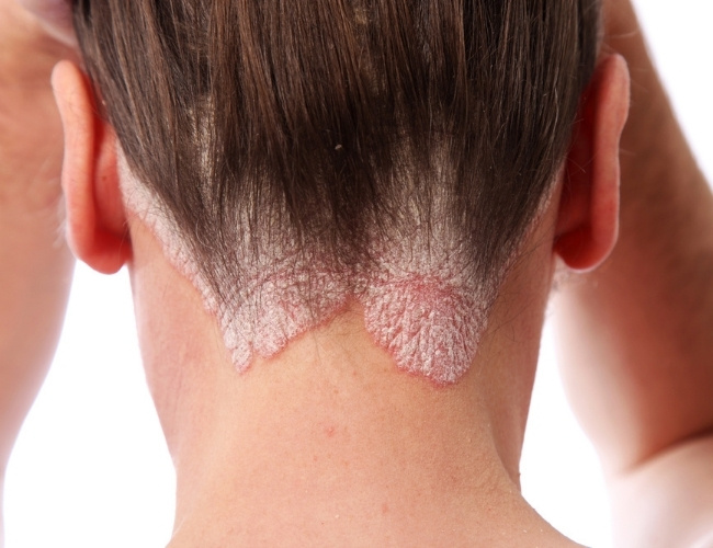Psoriasis Treatment in Oakville